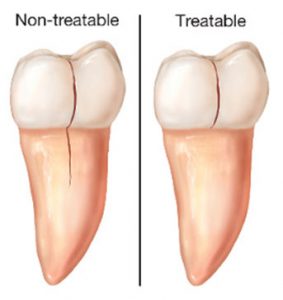 Cracked Teeth | NW Endodontics