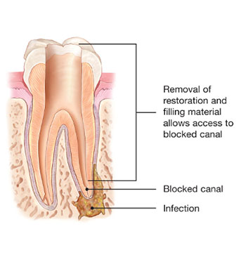 Endodontic Retreatment | NW Endodontics