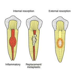 Resoprtion | NW Endodontics