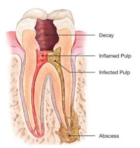Root Canal | NW Endodontics